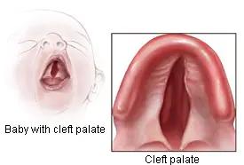 cleft_palate_small